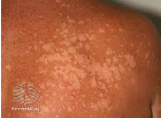 النخالية المبرقشة